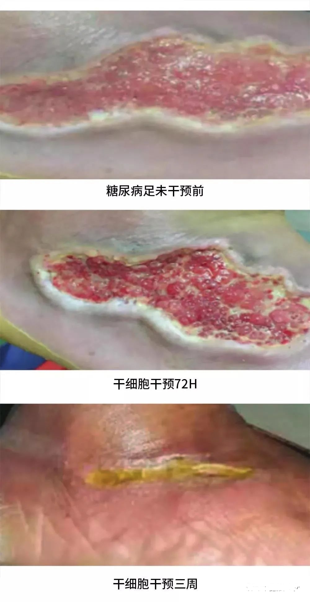 患者治療72小時化膿性分泌物和傷口大小明顯減少,3周后足部潰瘍幾乎愈合,足部行走功能也得到了恢復。 患者治療72小時化膿性分泌物和傷口大小明顯減少,3周后足部潰瘍幾乎愈合,足部行走功能也得到了恢復。