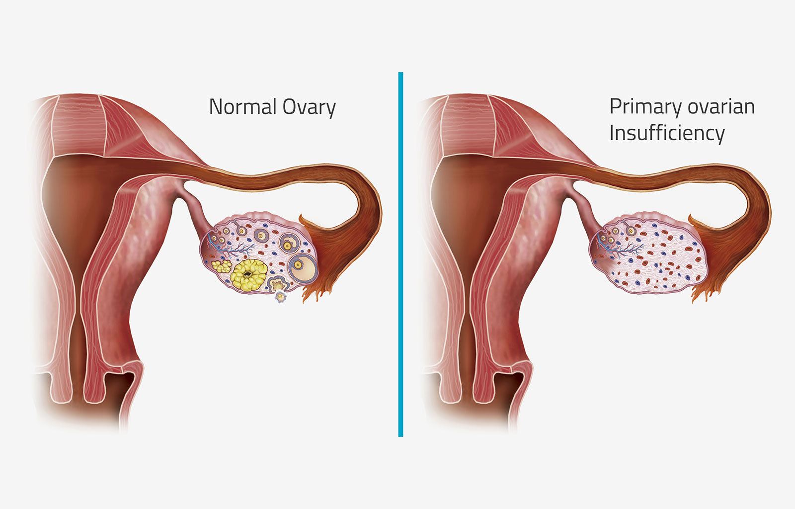 正常卵巢與患上卵巢早衰之后的卵巢對(duì)比 正常卵巢與患上卵巢早衰之后的卵巢對(duì)比