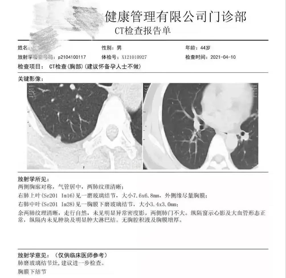 結果發現王先生右肺胸膜表面下(肺的內部),存在兩枚磨玻璃結節,其中較大者直徑7.6mm。 結果發現王先生右肺胸膜表面下(肺的內部),存在兩枚磨玻璃結節,其中較大者直徑7.6mm。