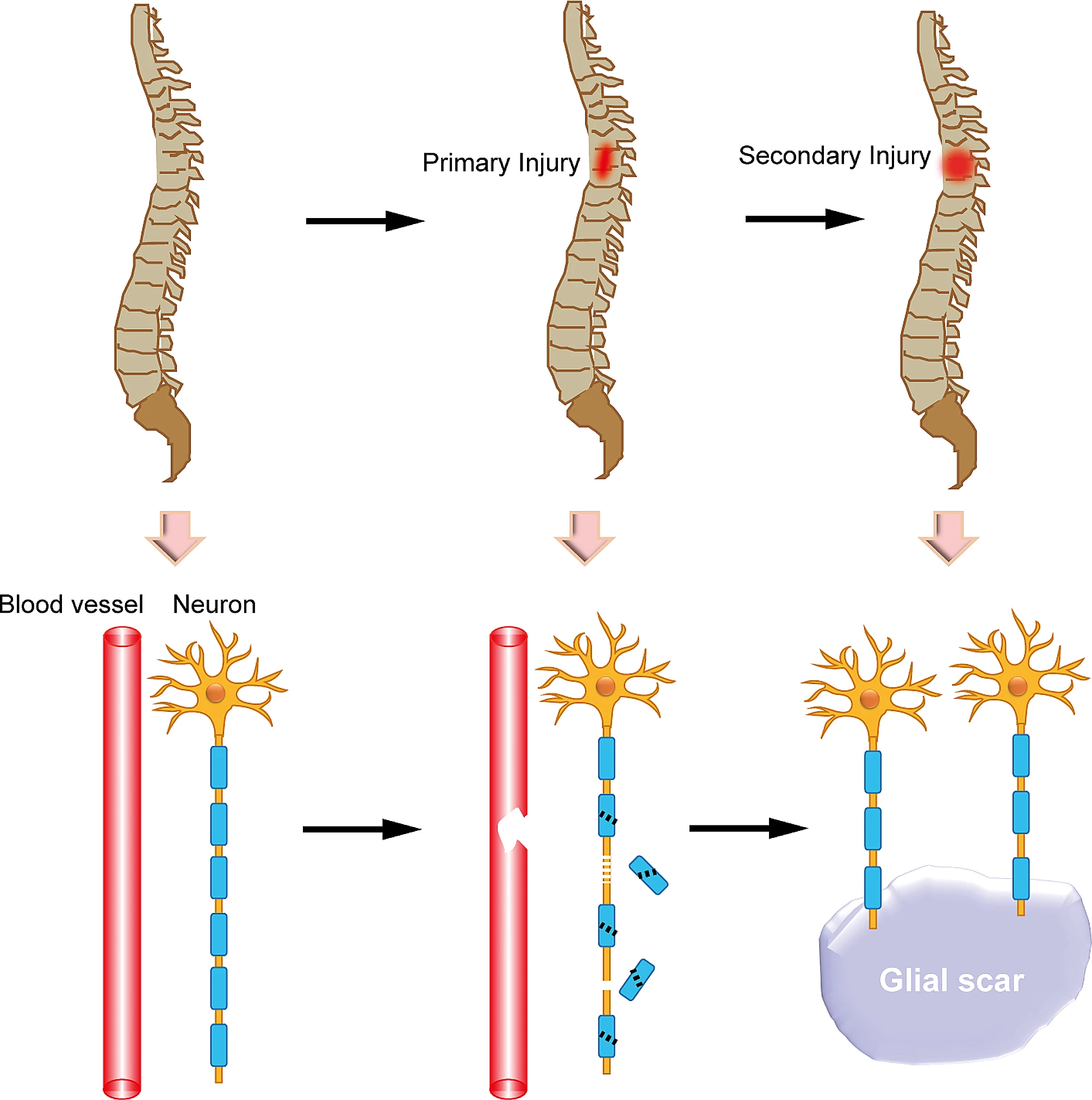 圖1:脊髓損傷后的原發性和繼發性損傷 圖1:脊髓損傷后的原發性和繼發性損傷