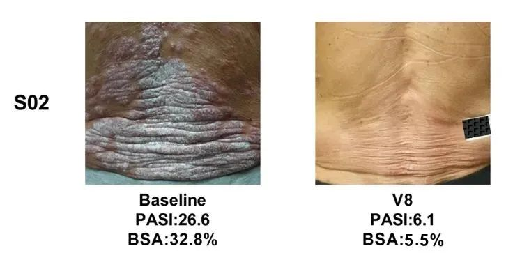 總共47.1% (8/17)的銀屑病患者在PASI(皮損面積和嚴(yán)重程度)評(píng)分中有至少40%的改善 總共47.1% (8/17)的銀屑病患者在PASI(皮損面積和嚴(yán)重程度)評(píng)分中有至少40%的改善