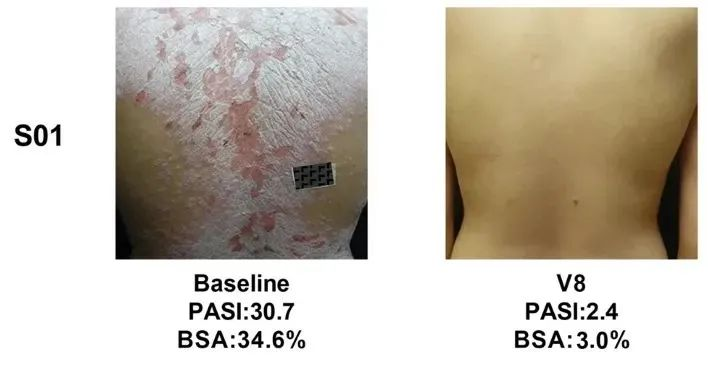 總共47.1% (8/17)的銀屑病患者在PASI（皮損面積和嚴(yán)重程度）評(píng)分中有至少40%的改善