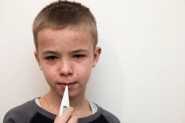 兒童狼瘡性腎炎-癥狀、原因和治療方法 兒童狼瘡性腎炎-癥狀、原因和治療方法