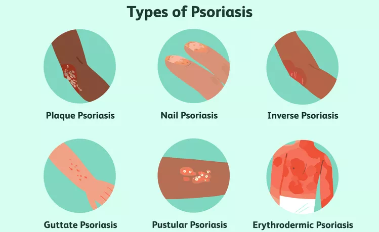 盤點(diǎn)國(guó)內(nèi)各大醫(yī)院運(yùn)用干細(xì)胞治療銀屑病的臨床應(yīng)用