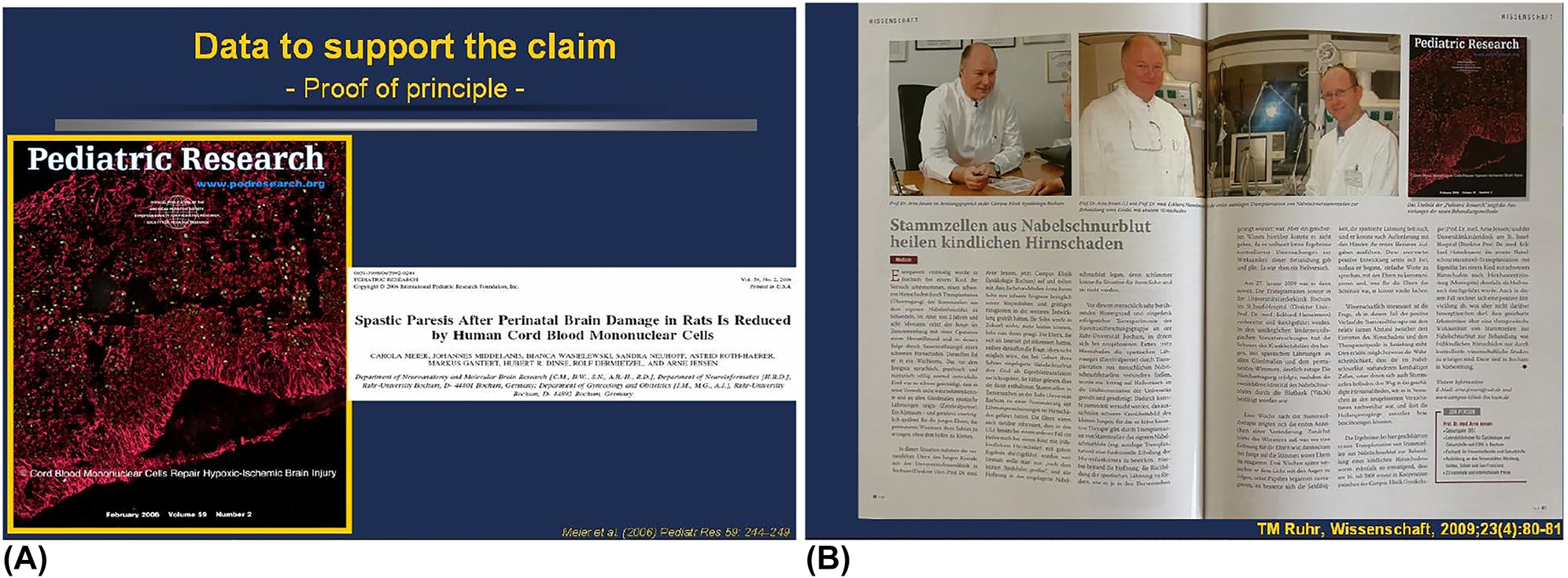 圖7:首次通過實驗和臨床證明臍帶血MNC可潛在治愈腦性癱瘓。 圖7:首次通過實驗和臨床證明臍帶血MNC可潛在治愈腦性癱瘓。