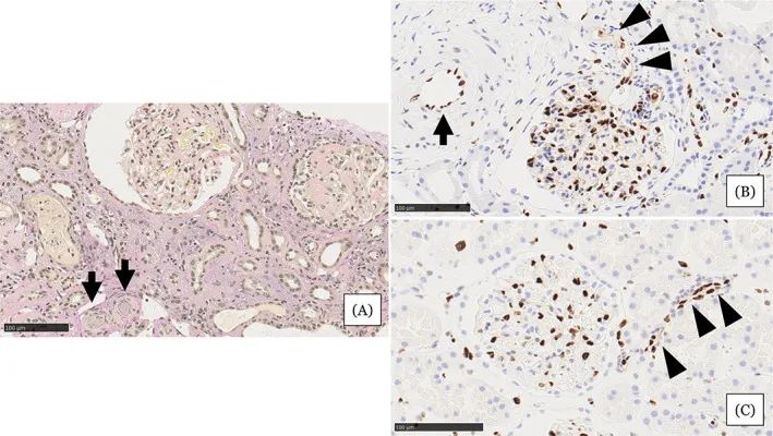 在住院第31天進行的腎活檢結(jié)果 在住院第31天進行的腎活檢結(jié)果
