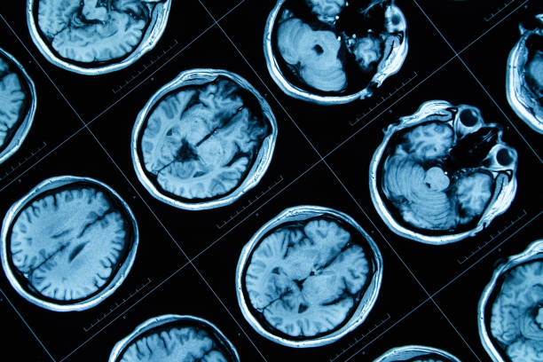 8.干細胞治療神經系統疾病 8.干細胞治療神經系統疾病