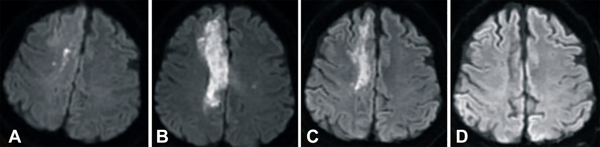 卒中發病后2小時和單核細胞臍帶血輸注后6個月獲得的彌散加權圖像 卒中發病后2小時和單核細胞臍帶血輸注后6個月獲得的彌散加權圖像