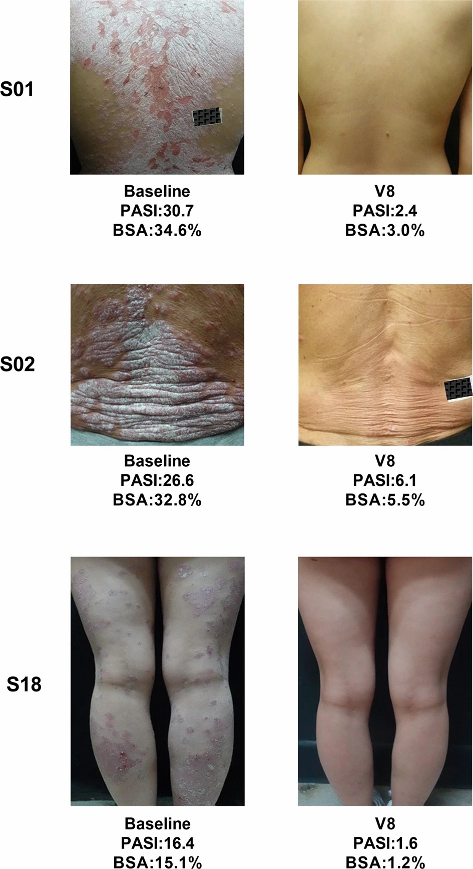 三名患者經(jīng)過治療后根據(jù) PGA 評分顯示無疾病跡象(評分為 0)或輕微疾病(評分為 1)。 三名患者經(jīng)過治療后根據(jù) PGA 評分顯示無疾病跡象(評分為 0)或輕微疾病(評分為 1)。