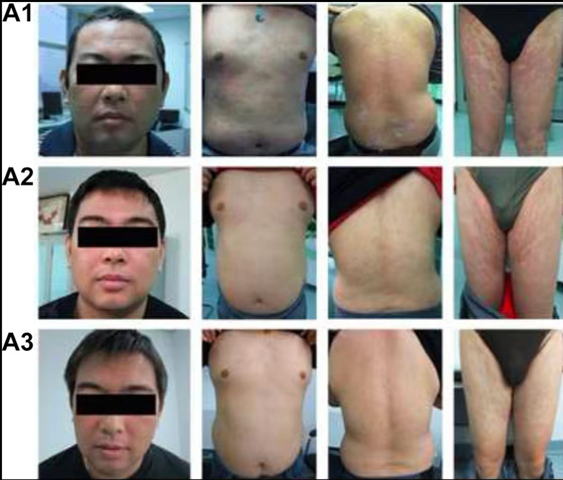 圖A1是患者治療前的皮膚情況 圖A2是患者治療6個月之后的皮膚情況 圖A3是患者治療12個月之后的皮膚情況 圖A1是患者治療前的皮膚情況
圖A2是患者治療6個月之后的皮膚情況
圖A3是患者治療12個月之后的皮膚情況