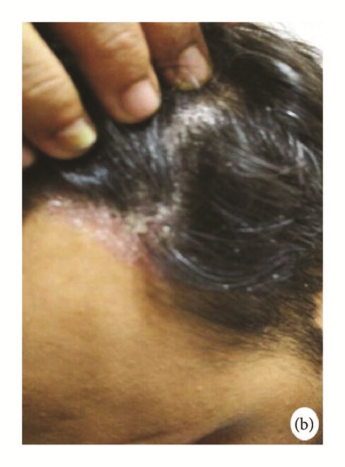 骨髓間充質(zhì)干細(xì)胞 治療前,患者頭皮上出現(xiàn)大量紅斑,并附著銀色鱗片(b)。 骨髓間充質(zhì)干細(xì)胞 治療前,患者頭皮上出現(xiàn)大量紅斑,并附著銀色鱗片(b)。