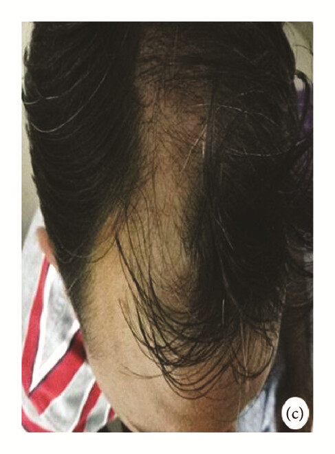 局部應(yīng)用骨髓間充質(zhì)干細(xì)胞一個月后,銀屑病消退,炎性紅斑完全清除(c)。 局部應(yīng)用骨髓間充質(zhì)干細(xì)胞一個月后,銀屑病消退,炎性紅斑完全清除(c)。