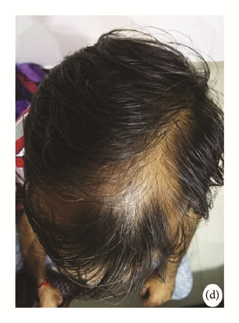 局部應(yīng)用骨髓間充質(zhì)干細(xì)胞一個月后,銀屑病消退,炎性紅斑完全清除(d)。 局部應(yīng)用骨髓間充質(zhì)干細(xì)胞一個月后,銀屑病消退,炎性紅斑完全清除(d)。