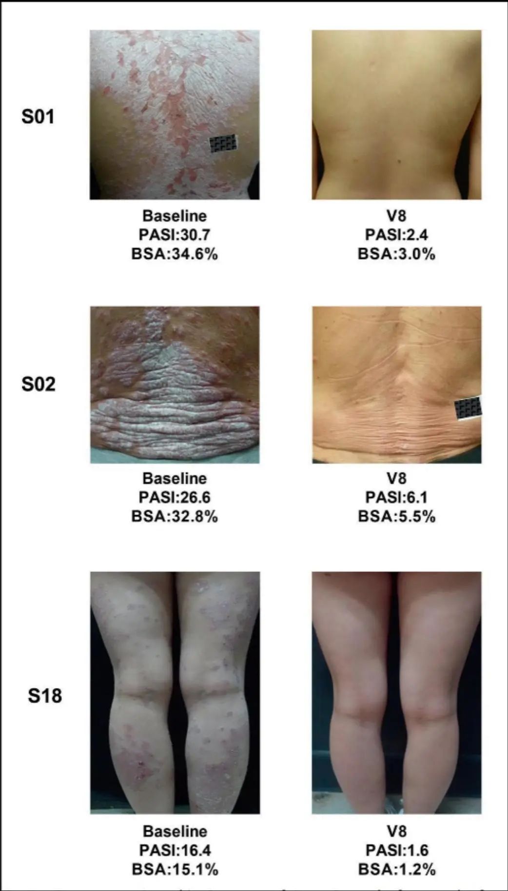 3名患者治療前后的代表性皮膚圖像 3名患者治療前后的代表性皮膚圖像