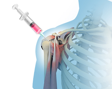 間充質干細胞需要注射幾次才會有效果? 間充質干細胞需要注射幾次才會有效果?