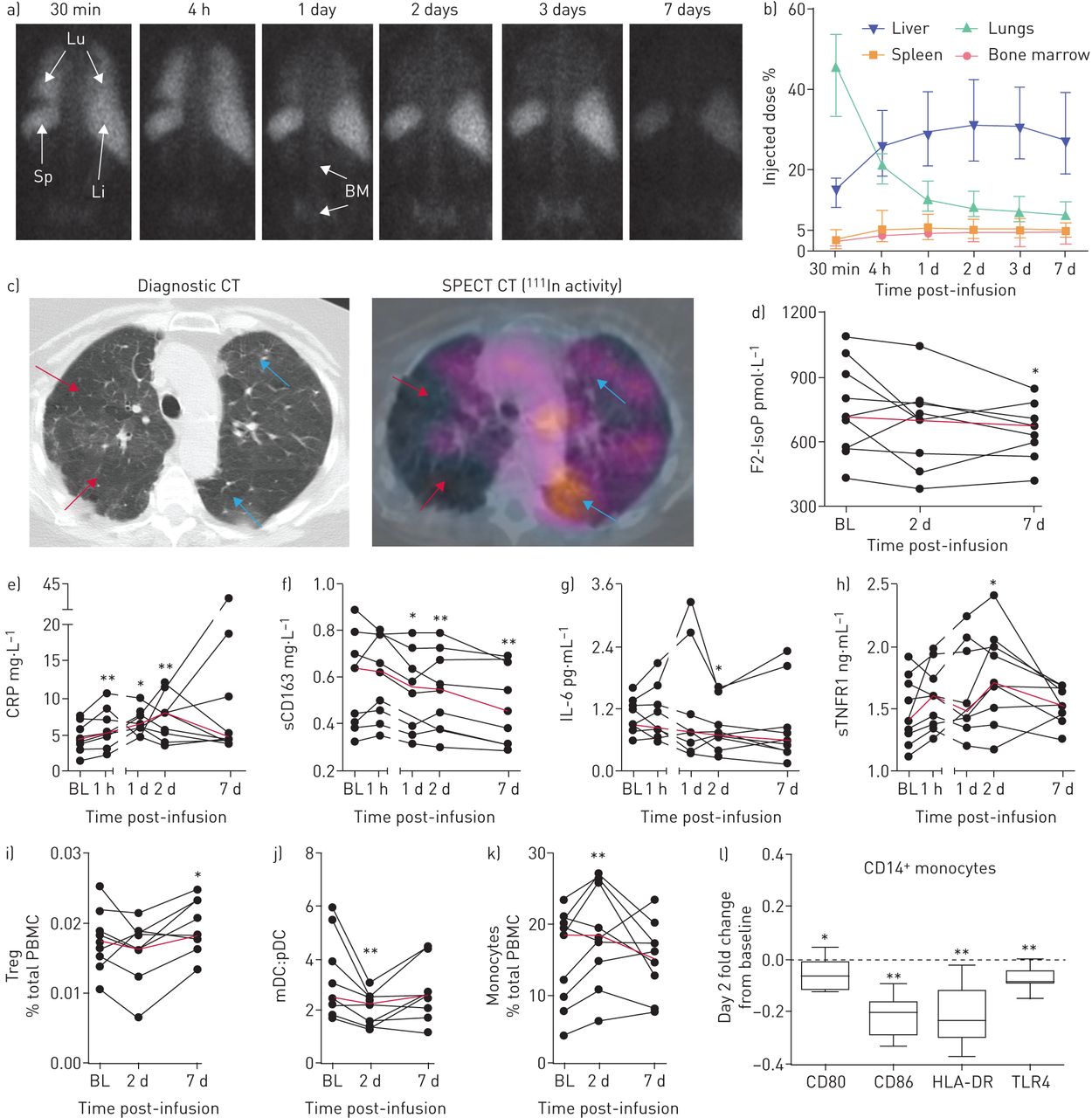 輸注后 7 天內,銦-111 存在于肺 (Lu) 中,其次是肝臟 (Li)、脾臟 (Sp) 和骨髓 (BM) (a) 通過感興趣區域 (ROI) 分析 (平均值和標準偏差) 定量測量,并根據背景和衰減進行校正 (b) 可見肺氣腫變化的區域顯示放射性標記的存在最少 (紅色箭頭),而受影響不太明顯的區域顯示放射性標記積累水平較高 (藍色箭頭) (c) 輸注 7 天后,氧化應激標志物 F2-異前列腺素 (F2-IsoP) 水平下降 (d) 促炎標志物如 C 反應蛋白 (CRP) 在輸注后 1 小時至 2 天內顯著升高 (e) 而可溶性 (s)CD163 水平從 1 天起下降 (f) 白細胞介素 (IL)-6 在輸注后 2 天下降 (g) 輸注后 2 天循環 sTNFR1 也增加 (h) 輸注后 7 天循環免疫細胞(包括調節性 T 細胞 (Tregs))的比例增加 (i) 而髓樣 (mDC) 與漿細胞樣 (pDC) 樹突狀細胞的比例降低 (j) 輸注后 2 天 CD14?+單核細胞水平增加 (k) 并且這些單核細胞在第 2 天與基線相比 CD80、CD86、人類白細胞抗原-DR (HLA-DR) 和 TLR4 顯著降低, (l) 每張放射圖像均顯示一名患者的代表性圖像。黑線代表每個患者的時間過程,紅線代表中位數,以顯示總體趨勢。使用 Wilcoxon 符號排序檢驗進行統計分析,以比較基線和輸注后水平。CT:計算機斷層掃描;SPECT:單光子發射計算機斷層掃描;PBMC:外周血單核細胞。