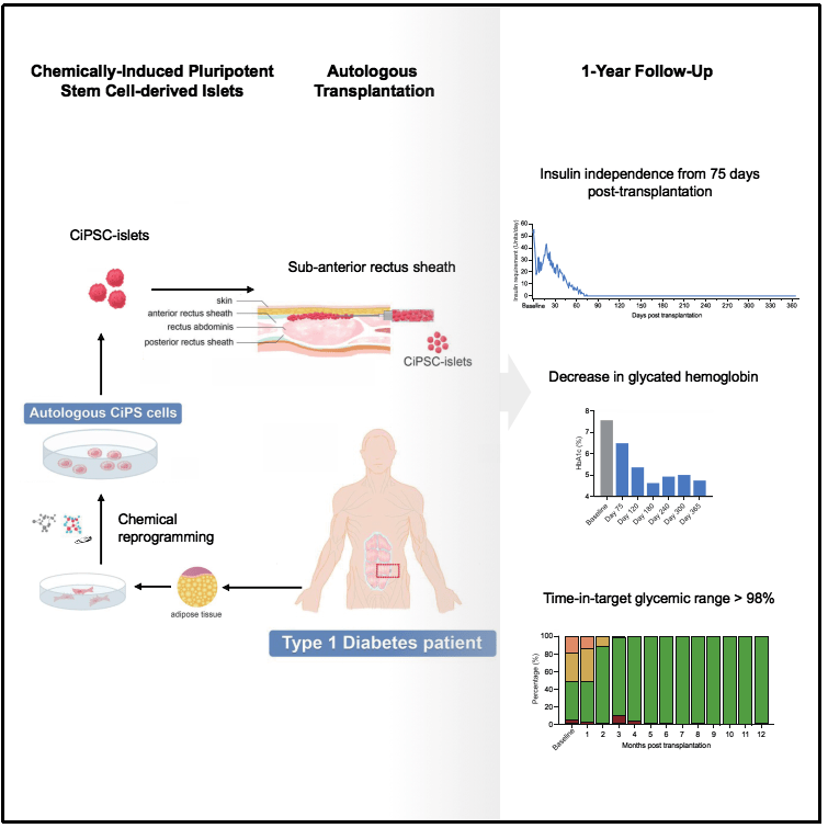 圖1:基于CiPS細胞治療1型糖尿病的臨床研究的示意圖和治療效果 圖1:基于CiPS細胞治療1型糖尿病的臨床研究的示意圖和治療效果