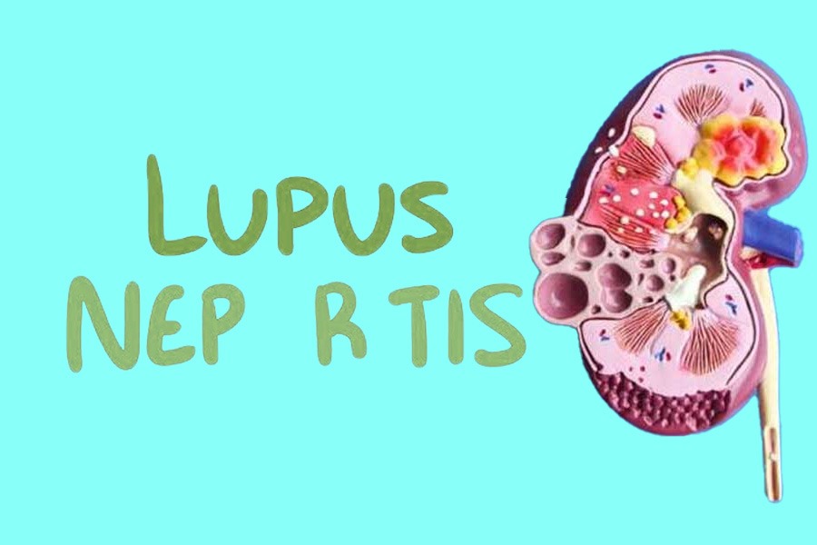干細胞治療狼瘡性腎炎:2019-2024年臨床研究進展回顧 干細胞治療狼瘡性腎炎:2019-2024年臨床研究進展回顧