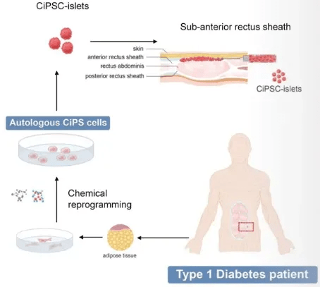干細(xì)胞技術(shù)將成為糖尿病治療的新里程碑 干細(xì)胞技術(shù)將成為糖尿病治療的新里程碑