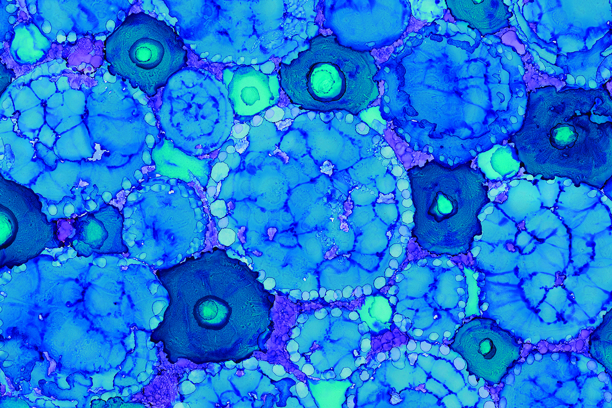 歷年來Vertex的干細胞治療1型糖尿病的研究進展 歷年來Vertex的干細胞治療1型糖尿病的研究進展