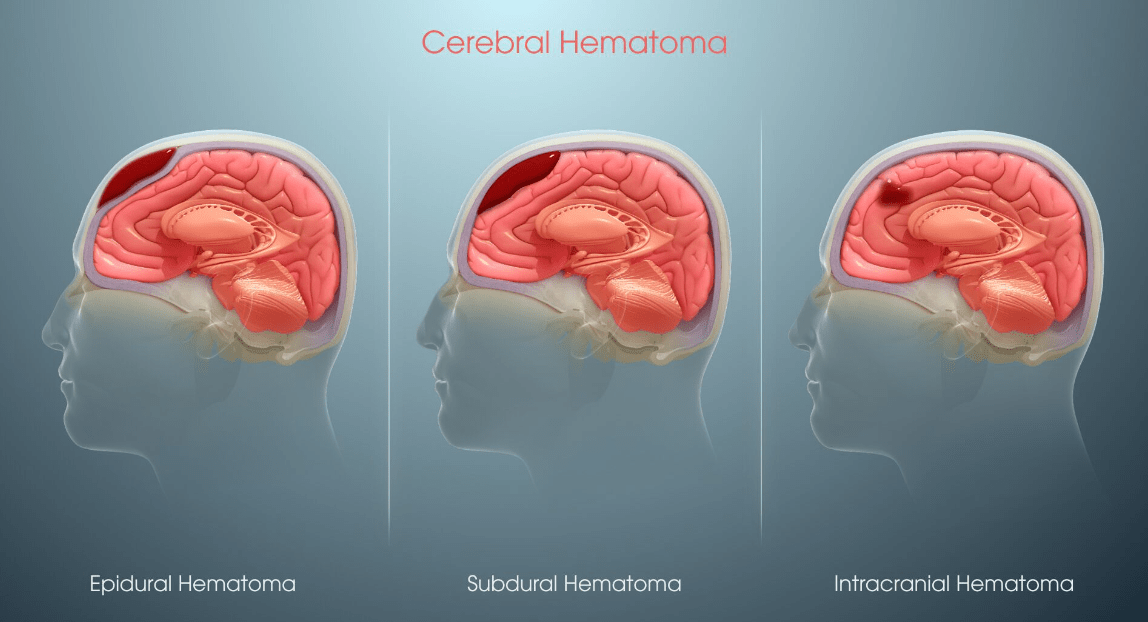 NR-20201:治療腦卒中的新希望 NR-20201:治療腦卒中的新希望
