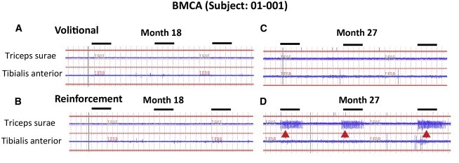 圖2:患者1腦運(yùn)動控制評估(BMCA)和EMG評估 圖2:患者1腦運(yùn)動控制評估(BMCA)和EMG評估