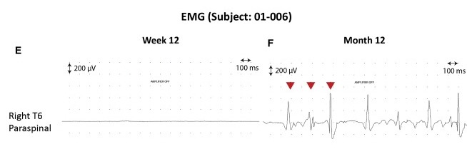 圖3:患者2腦運(yùn)動控制評估(BMCA)和EMG評估 圖3:患者2腦運(yùn)動控制評估(BMCA)和EMG評估