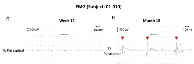 圖4:患者4腦運(yùn)動控制評估(BMCA)和EMG評估 圖4:患者4腦運(yùn)動控制評估(BMCA)和EMG評估