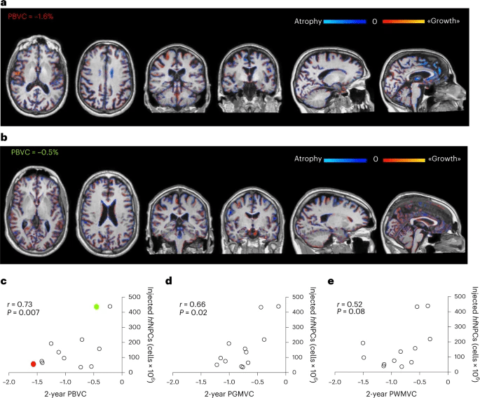 圖5:注射的神經干細胞數量與腦容量損失呈反比 圖5:注射的神經干細胞數量與腦容量損失呈反比