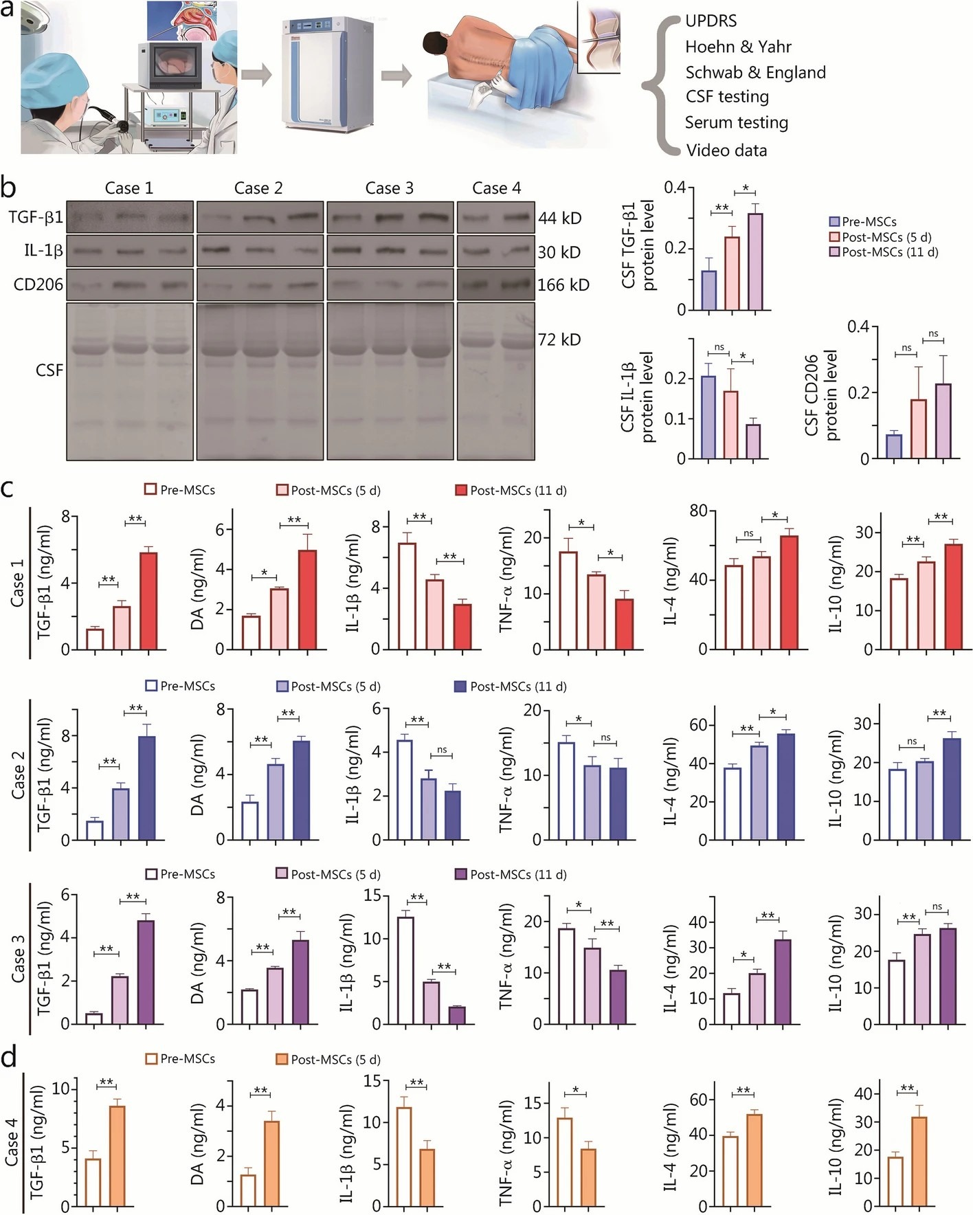 帕金森病患者 I 期 hOM-MSC 植入臨床試驗(yàn) 帕金森病患者 I 期 hOM-MSC 植入臨床試驗(yàn)