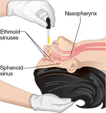 干細胞輸送方法有13種,其中干細胞移植的過程都是什么樣的?