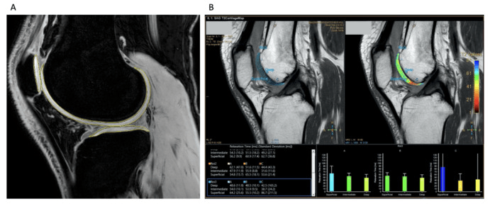 圖2:定量圖像MRI分析 圖2:定量圖像MRI分析