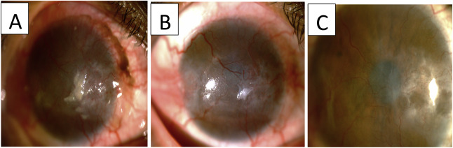 右眼 眼表鱗狀腫瘤照片。 右眼 眼表鱗狀腫瘤照片。