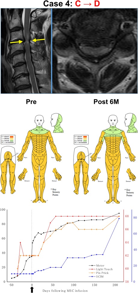 干細胞治療后患者的恢復狀態圖 干細胞治療后患者的恢復狀態圖
