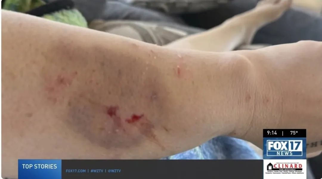 在接受干細胞治療前表現(xiàn)出嚴重的自閉癥癥狀,甚至曾咬傷母親安吉拉,留下了永久的疤痕 在接受干細胞治療前表現(xiàn)出嚴重的自閉癥癥狀,甚至曾咬傷母親安吉拉,留下了永久的疤痕