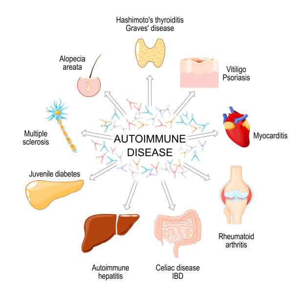 間充質干細胞療法:一種在10種自身免疫性疾病中有前景的治療方法 間充質干細胞療法:一種在10種自身免疫性疾病中有前景的治療方法
