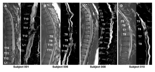MRI頸胸T2矢狀圖和AvDC矢狀圖 MRI頸胸T2矢狀圖和AvDC矢狀圖