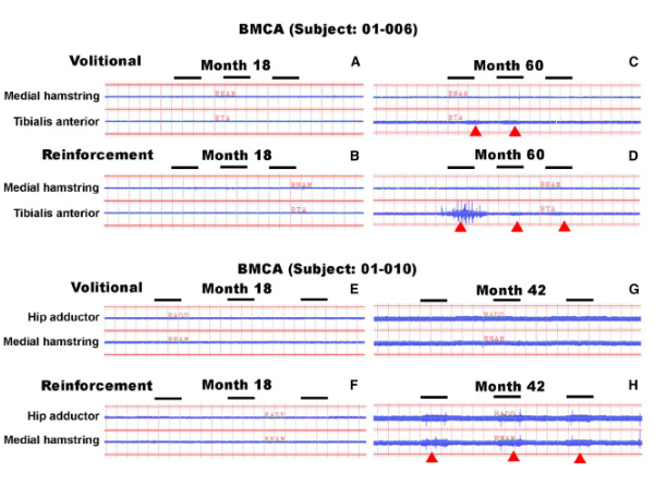 BMCA 識別自愿或強化動作引發的 EMG 活動 BMCA 識別自愿或強化動作引發的 EMG 活動