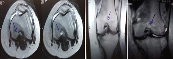 治療前 MRI 顯示內側和外側半月板后角 III 級撕裂。 治療前 MRI 顯示內側和外側半月板后角 III 級撕裂。