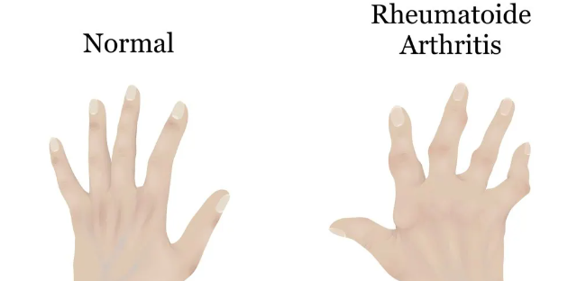 干細胞治療類風濕關節炎：如何實現從短期關節功能改善到長期的生活質量提升？
