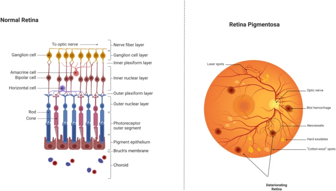 圖6:正常視網膜與受視網膜色素變性影響的視網膜的比較。 圖6:正常視網膜與受視網膜色素變性影響的視網膜的比較。