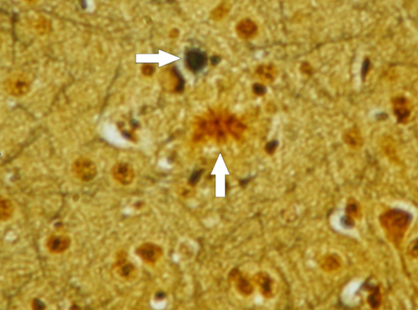 圖4:本圖描繪了三重轉基因小鼠模型中阿爾茨海默病的病理特征。 圖4:本圖描繪了三重轉基因小鼠模型中阿爾茨海默病的病理特征。
