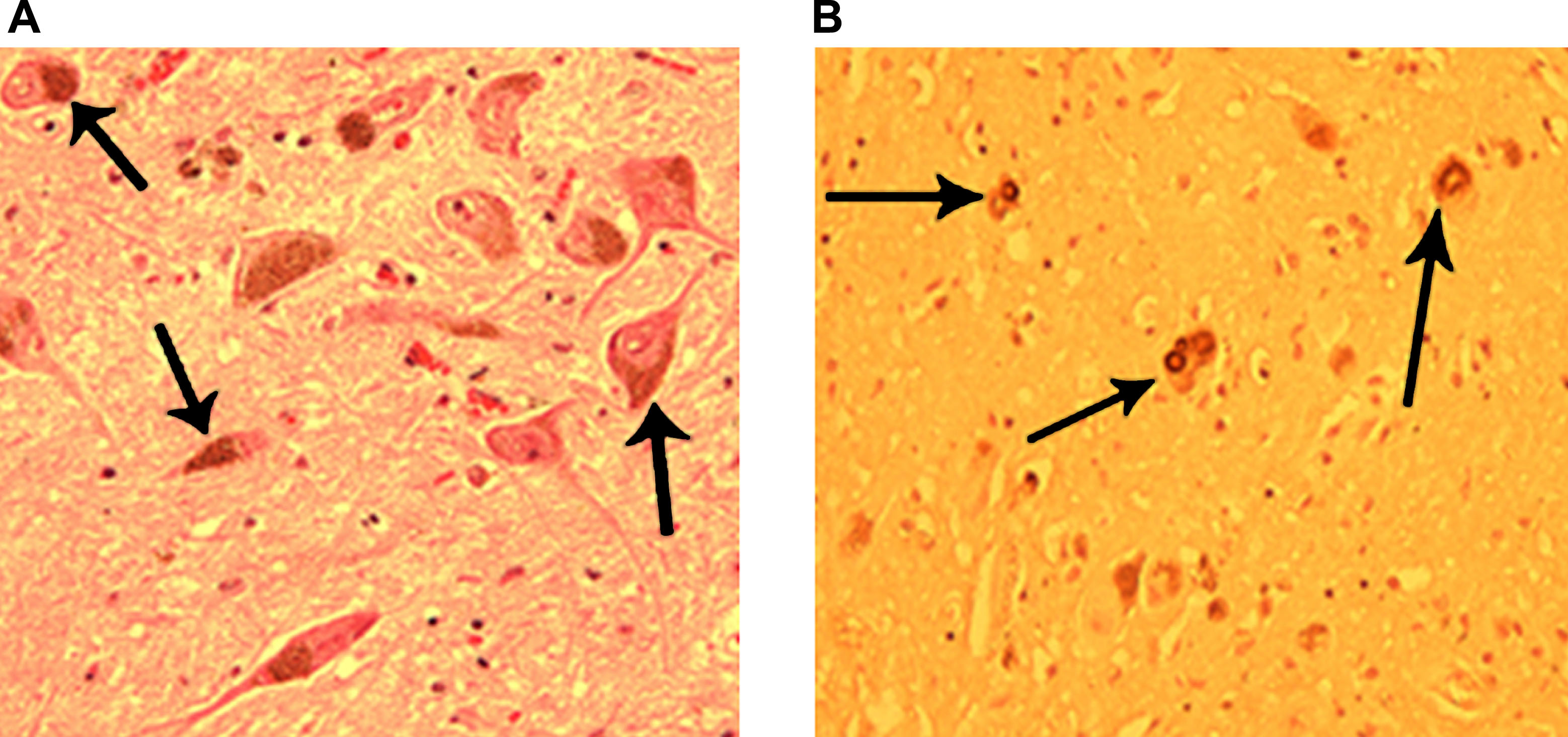 圖3:正常和帕金森病患者的黑質。 圖3:正常和帕金森病患者的黑質。