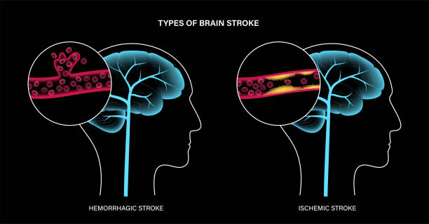 從癱瘓到復(fù)健!神經(jīng)干細(xì)胞療法5大機(jī)制如何促進(jìn)中風(fēng)后的大腦修復(fù)? 從癱瘓到復(fù)健!神經(jīng)干細(xì)胞療法5大機(jī)制如何促進(jìn)中風(fēng)后的大腦修復(fù)?