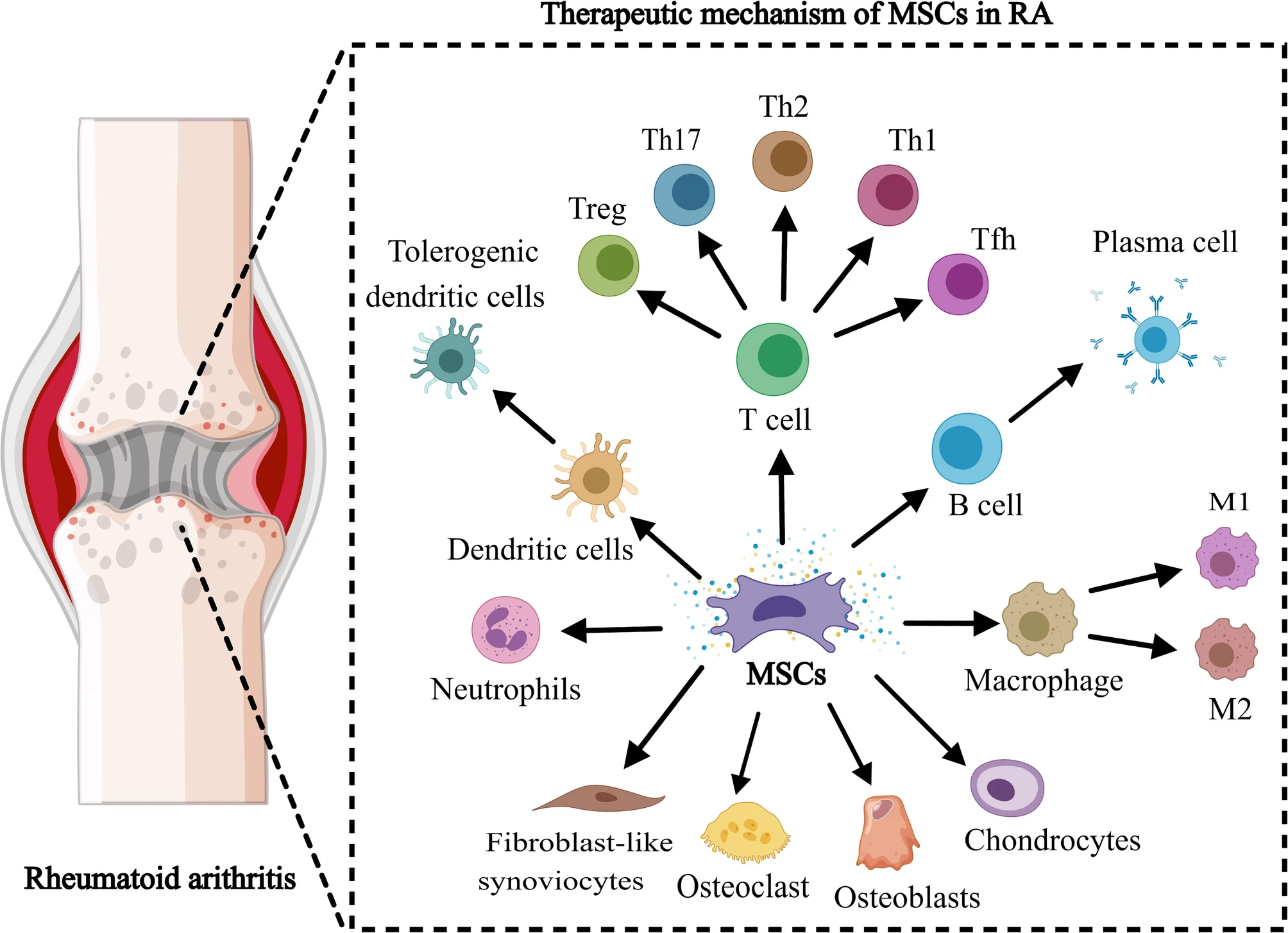 間充質干細胞治療類風濕性關節炎中的作用機制 間充質干細胞治療類風濕性關節炎中的作用機制