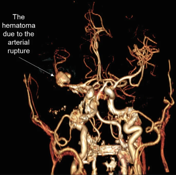 圖2:出血導致中風 圖2:出血導致中風