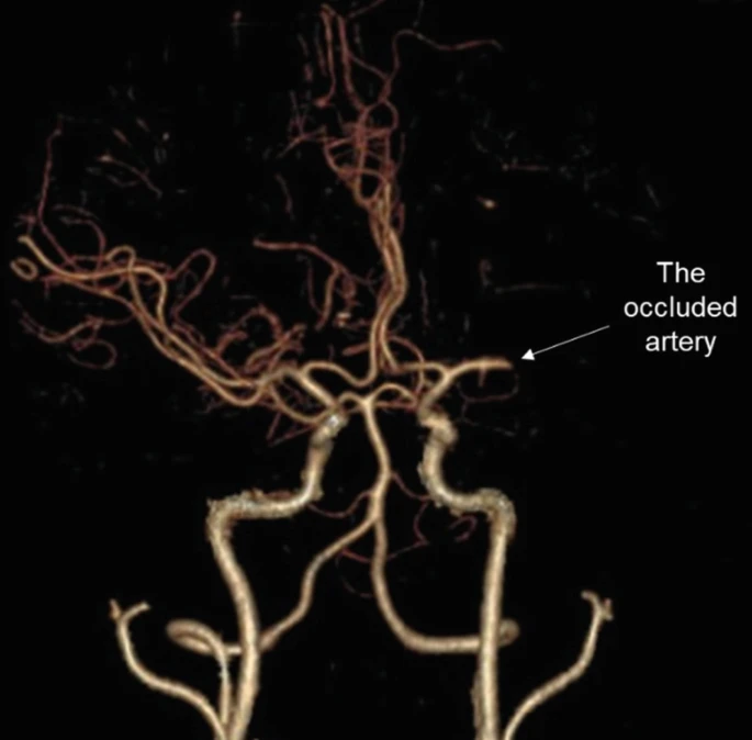 圖1:動脈閉塞導致的缺血性中風 圖1:動脈閉塞導致的缺血性中風