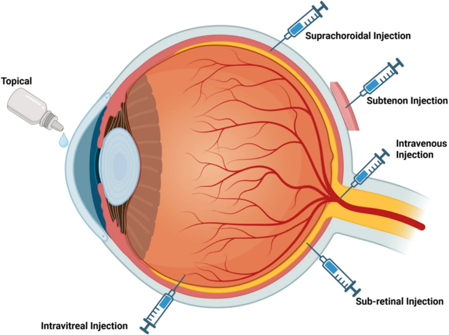 圖2:眼部基因和干細(xì)胞治療的給藥途徑 圖2:眼部基因和干細(xì)胞治療的給藥途徑
