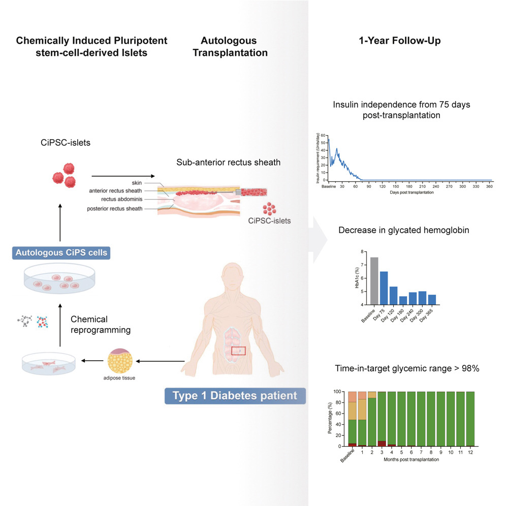 化學誘導多能干細胞衍生的胰島自體移植一年隨訪 化學誘導多能干細胞衍生的胰島自體移植一年隨訪