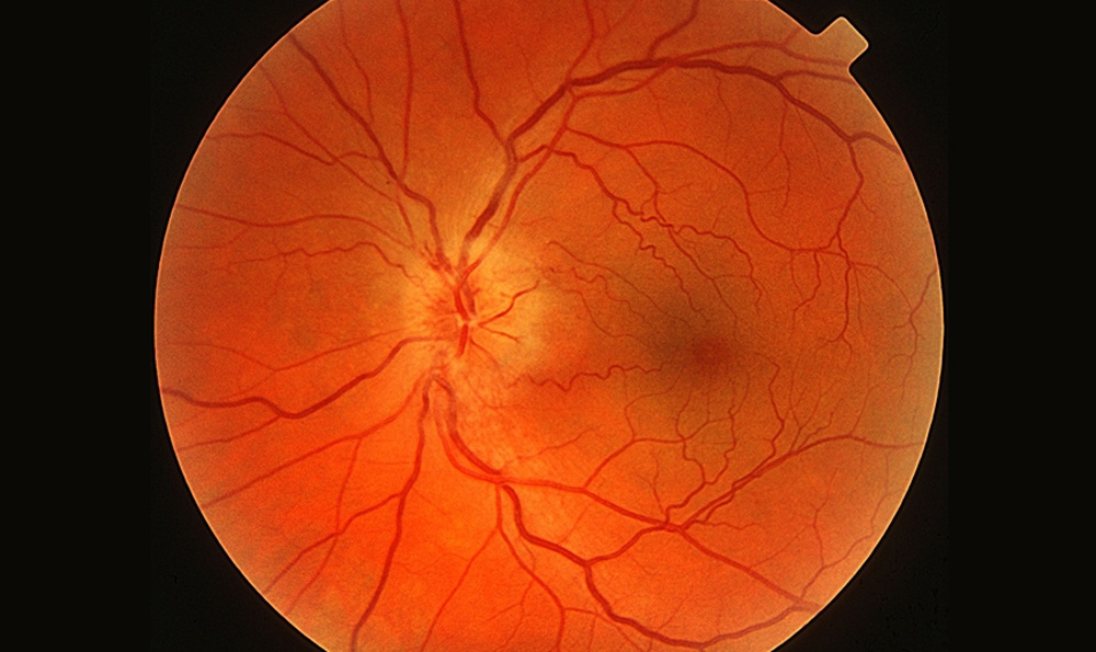 視神經(jīng)萎縮 視神經(jīng)萎縮